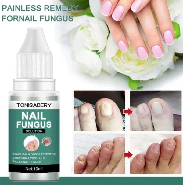 Uñas hongos tratamientos